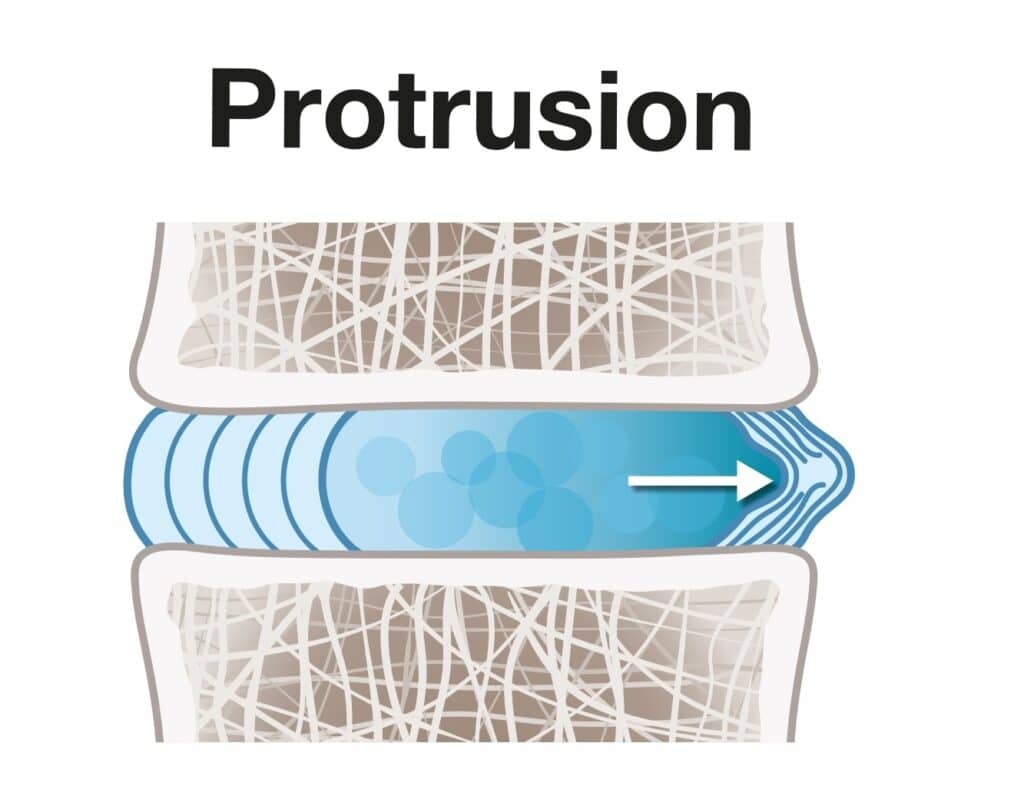 Disc Protrusion Definition Spine Info