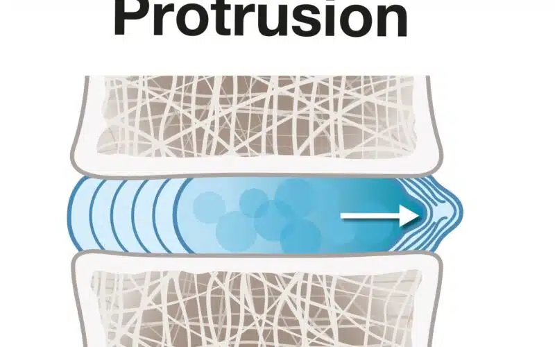 Disc Protrusion