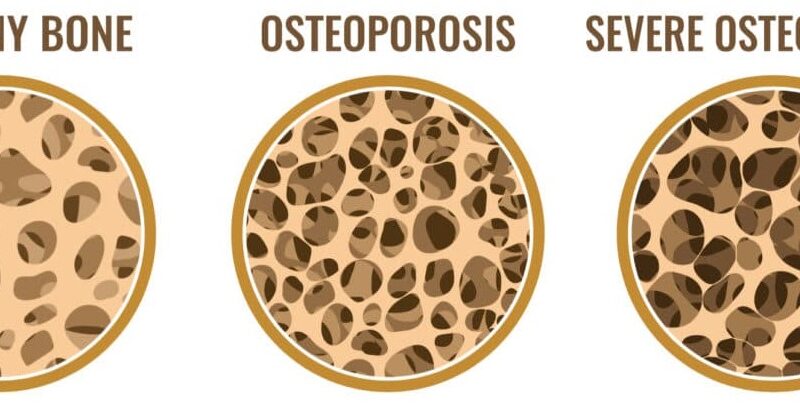 Osteoporosis of the Spine