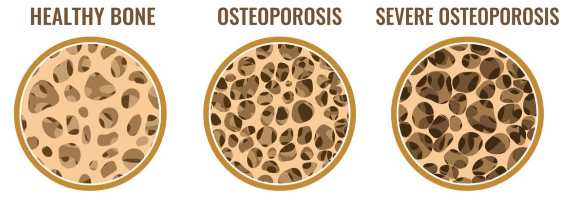 Osteoporosis of the Spine