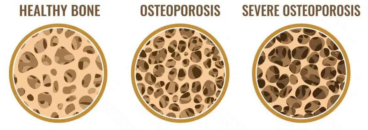 Osteoporosis of the Spine