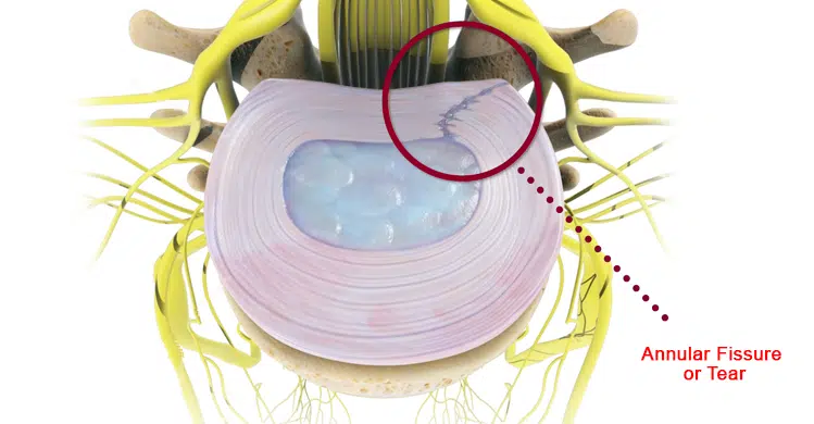 Annular Fissure or Tear