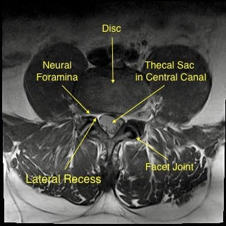Spine MRI axial view