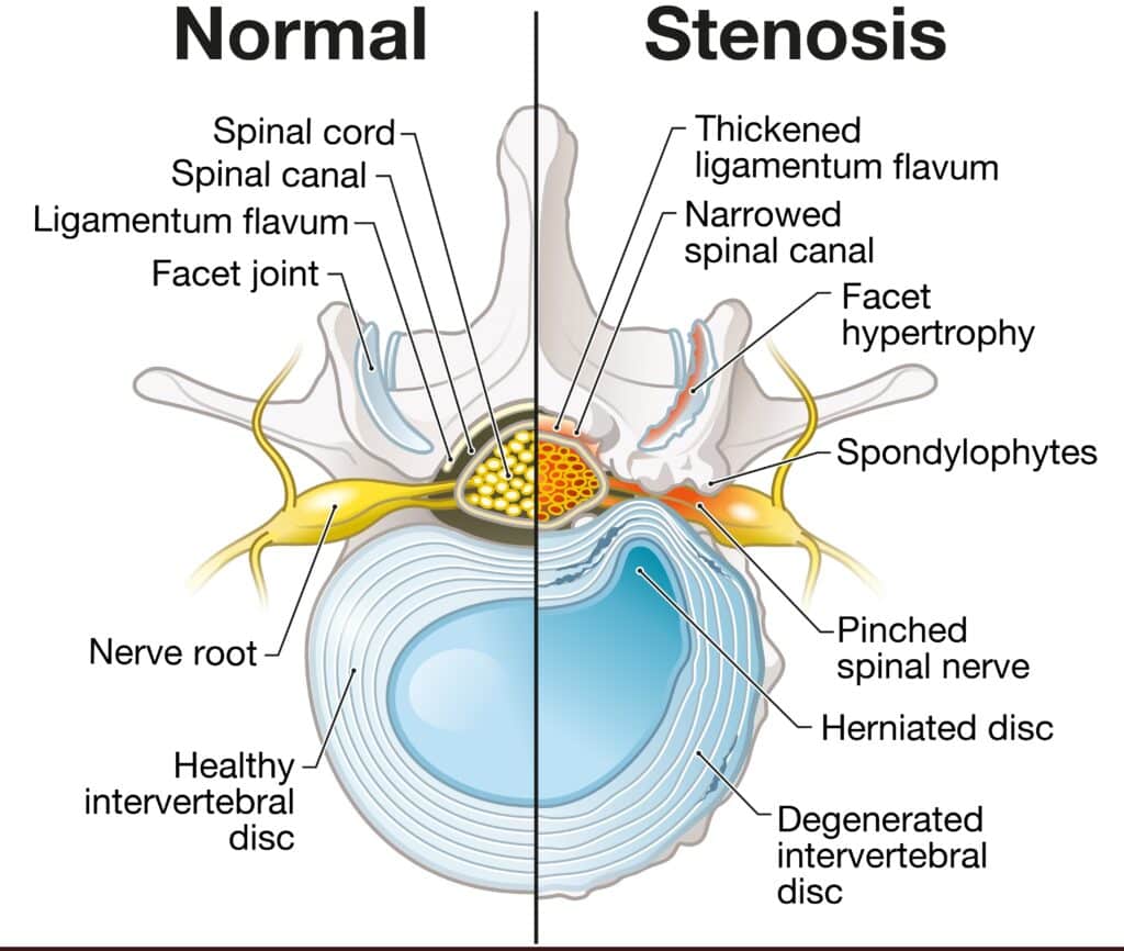 Normal Spine vs Central Canal Stenosis