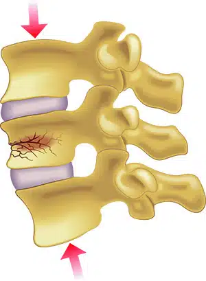 compression fracture