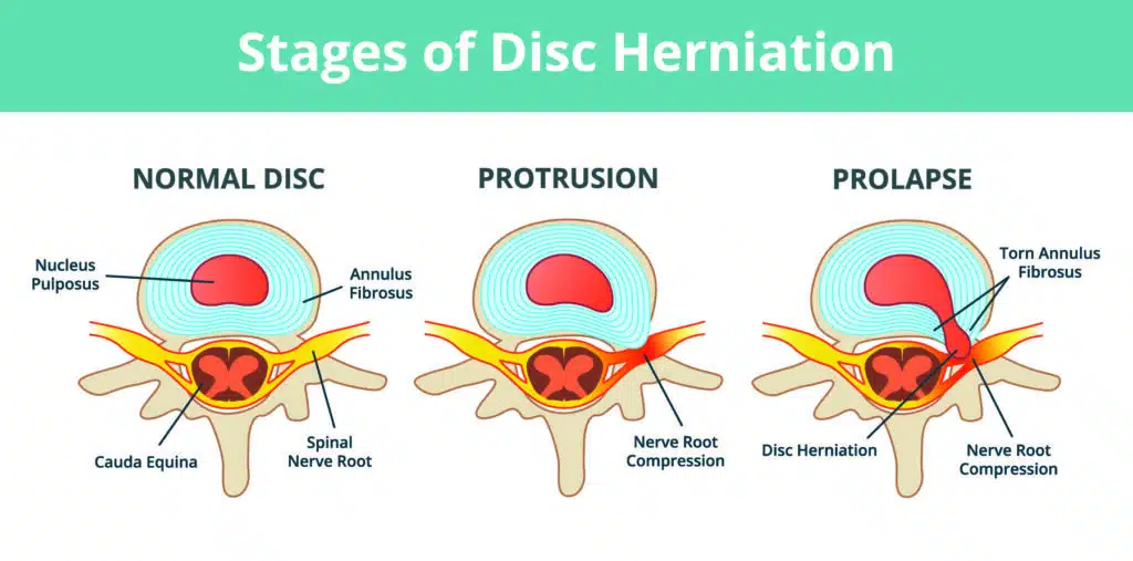 Disc Herniation or Bulge