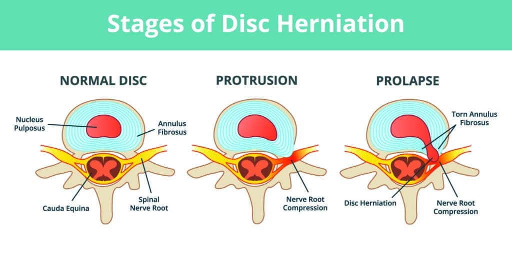 Disc Bulge Definition Spine Info