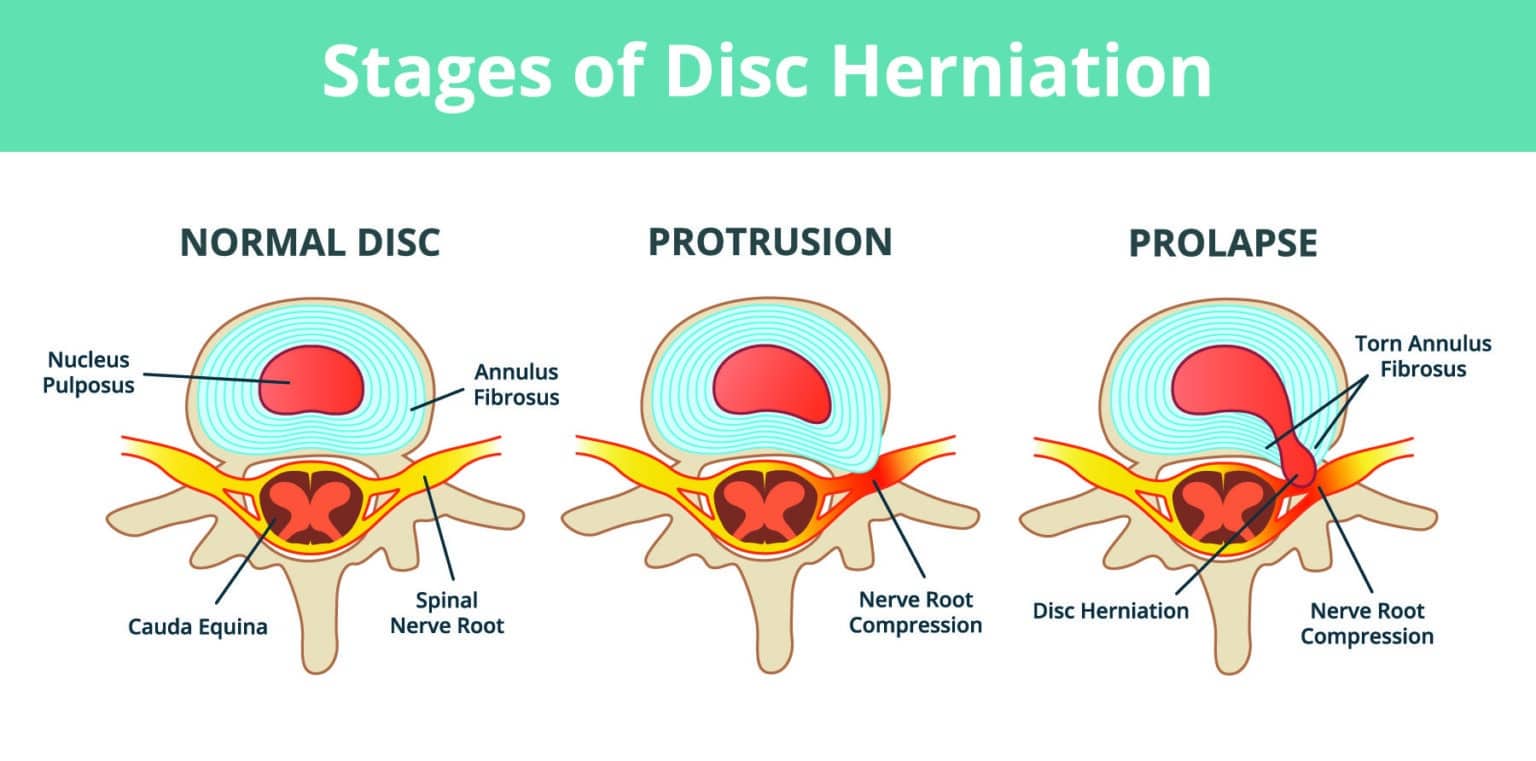 Disc Bulge Definition Spine Info