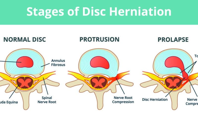 Disc Herniation or Bulge