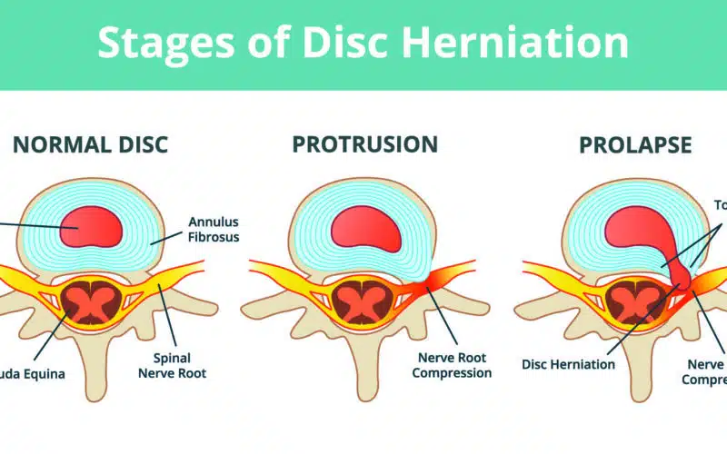 Disc Herniation or Bulge