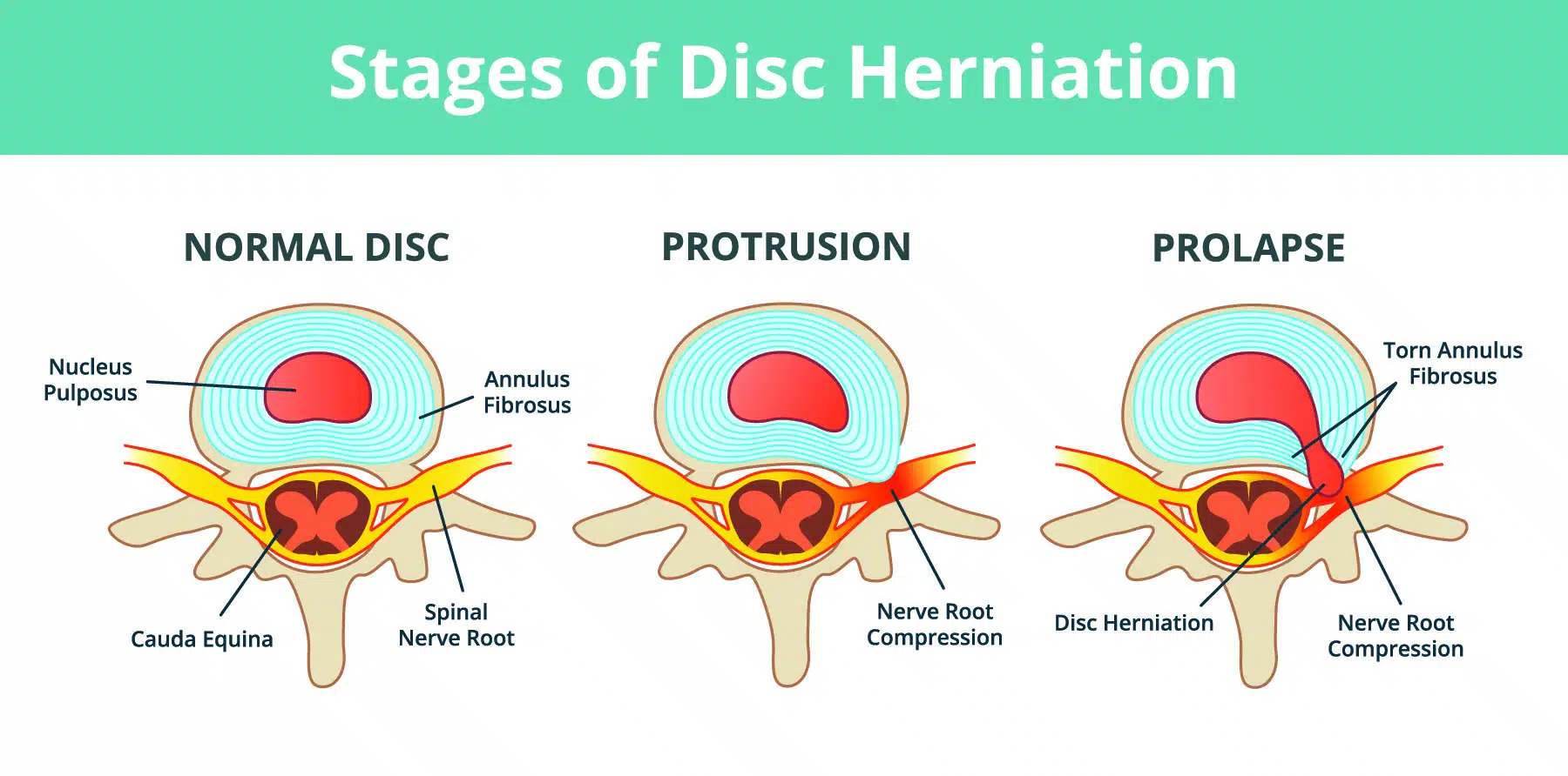 Disc Herniation or Bulge