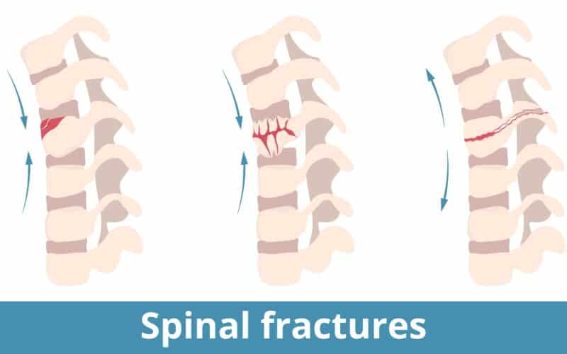 Examples of Spinal Fractures