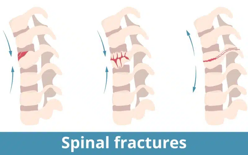 Examples of Spinal Fractures