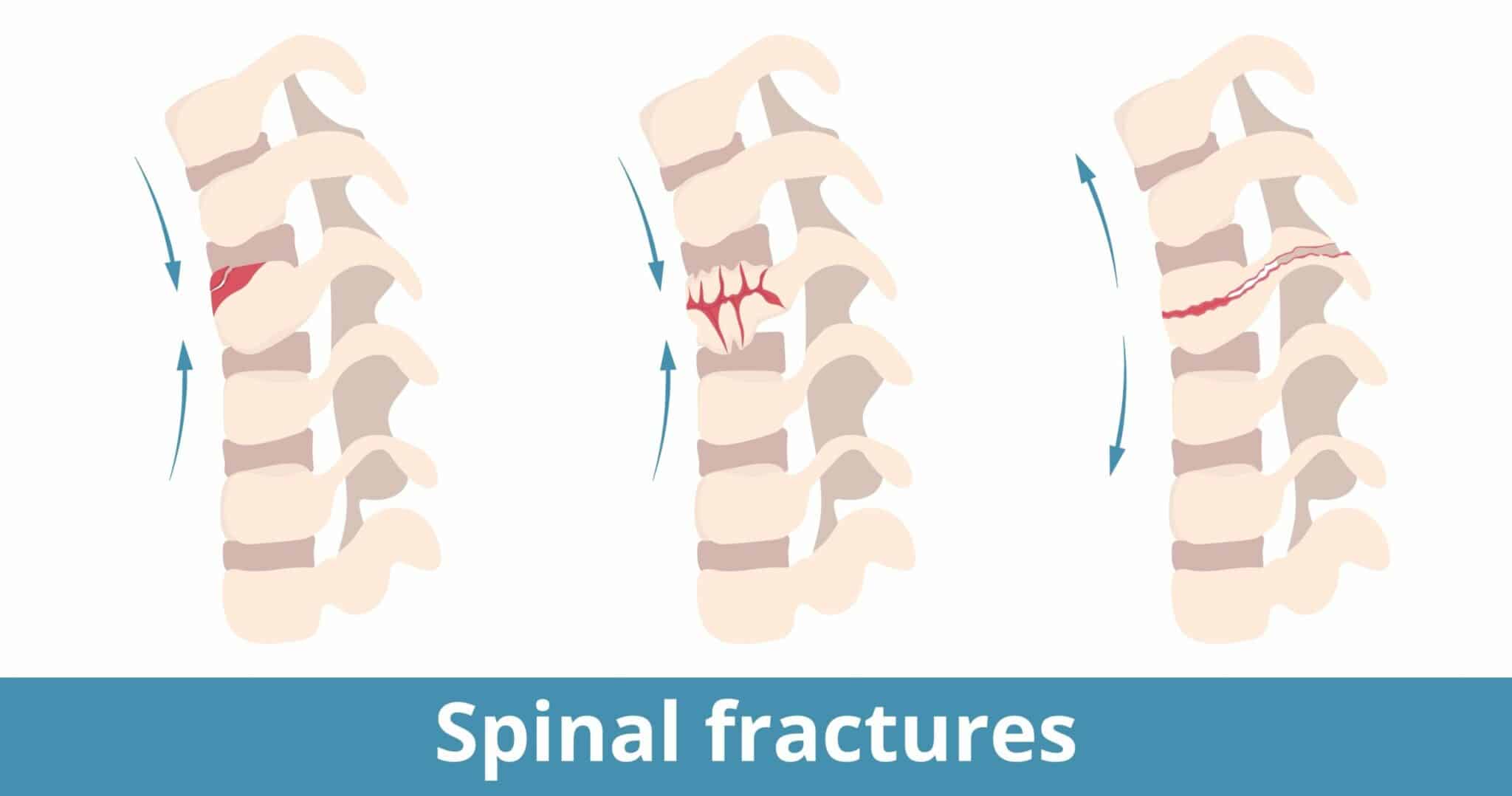 Examples of Spinal Fractures