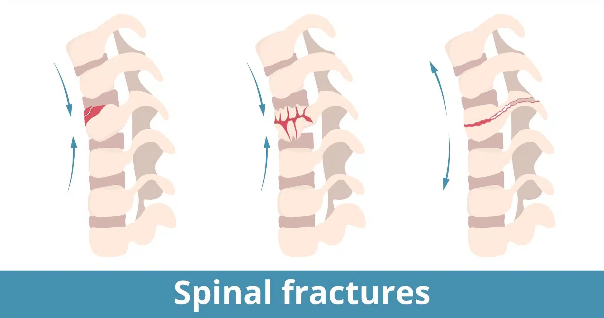 Examples of Spinal Fractures