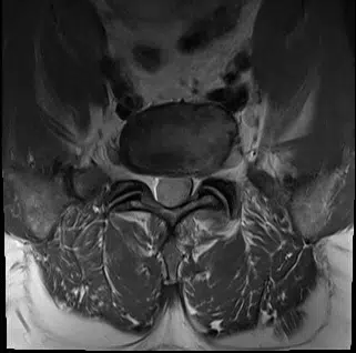 Spine MRI axial disc level