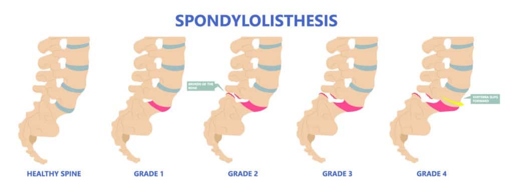 Grades of Spondylolisthesis