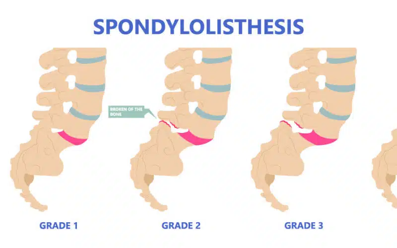 Spondylolisthesis