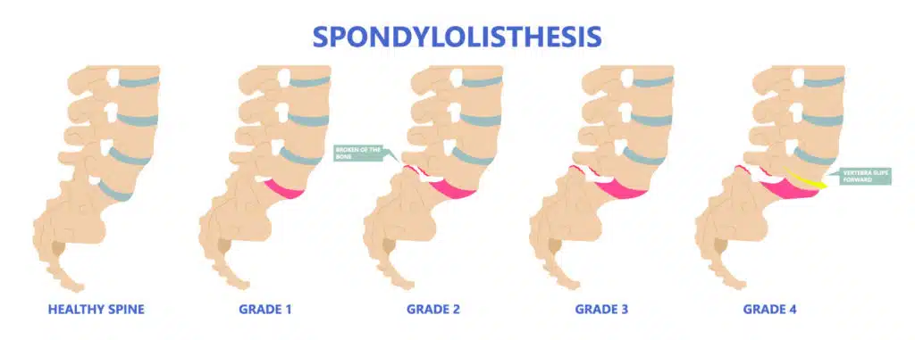 spondylolisthesis grade 4 symptoms
