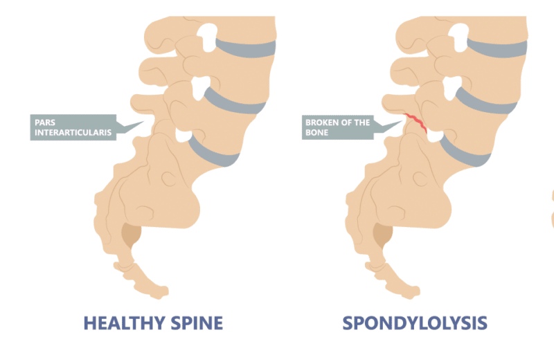 Image of Spondylosis as Compared to a Normal Spine
