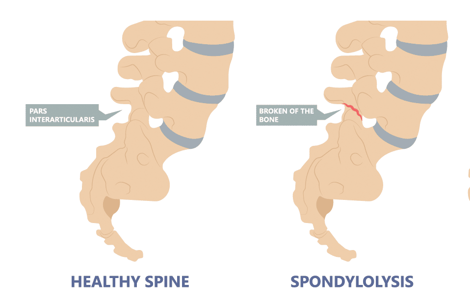 Image of Spondylosis as Compared to a Normal Spine