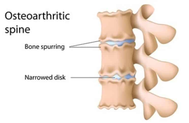 Spinal Arthritis Definition, Causes, Symptoms, Diagnosis, and