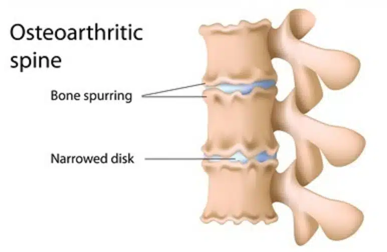 Osteoarthritis