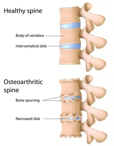 Healthy Spine Compared to Osteoarthritic Spine