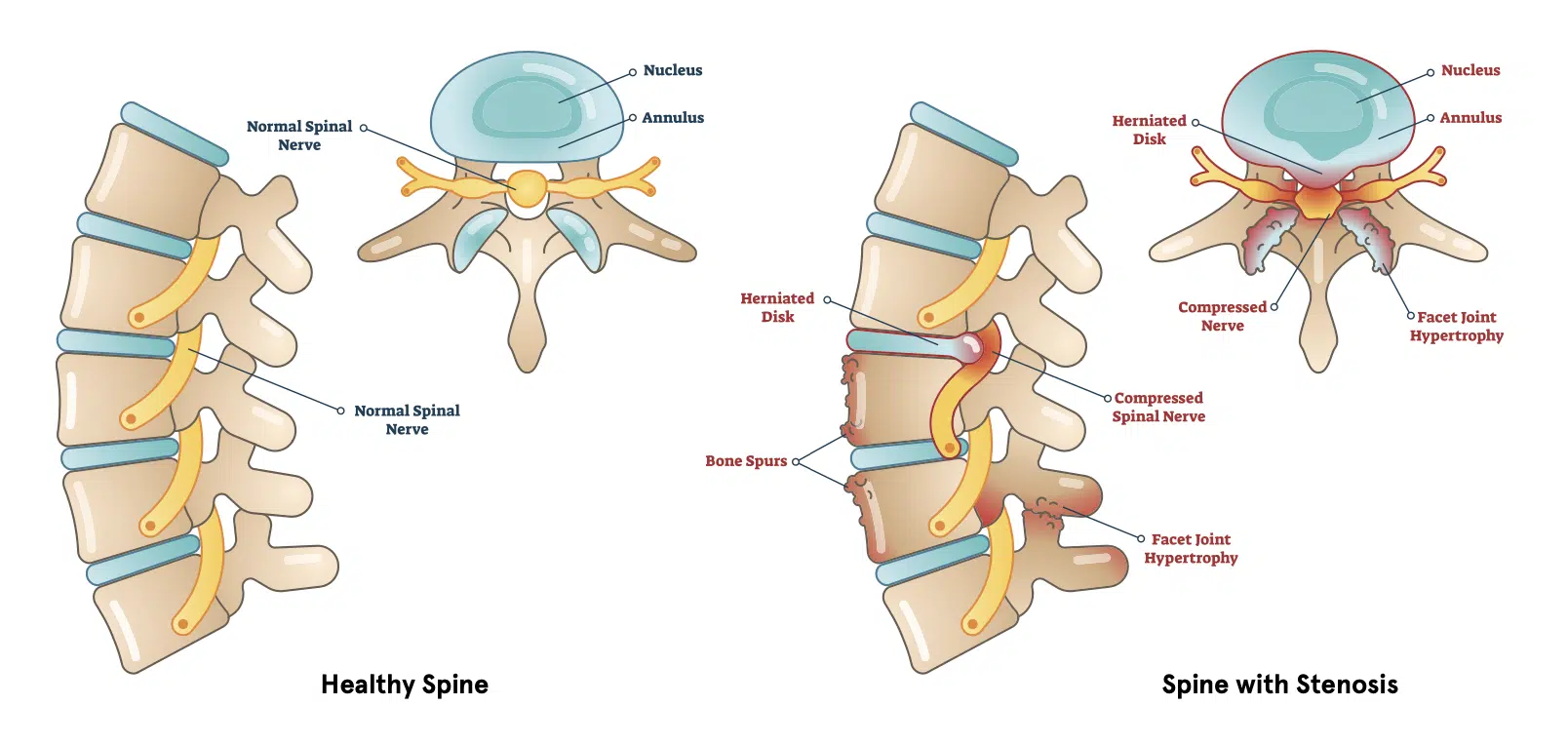 Spinal Stenosis Definition, Causes, Symptoms, Diagnosis, and Treatment