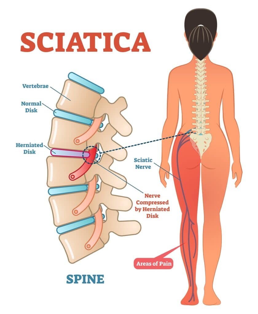 Image of sciatic nerve being compressed