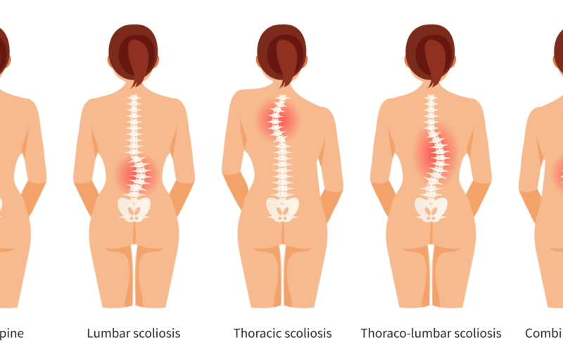 Scoliosis