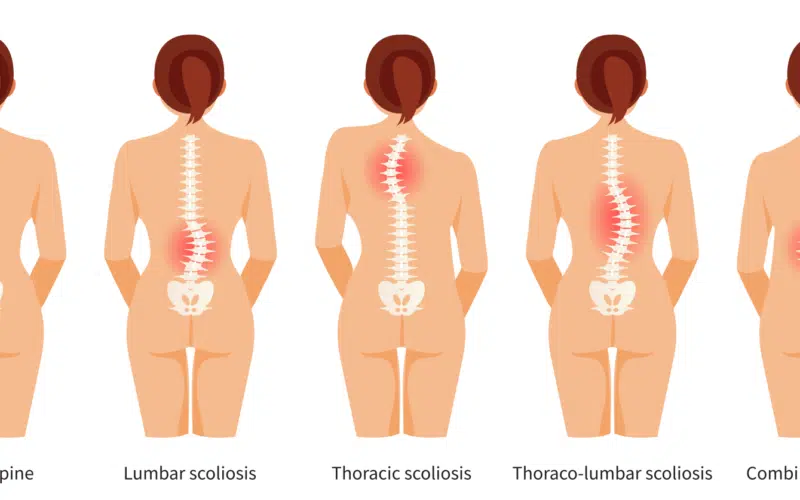 Scoliosis