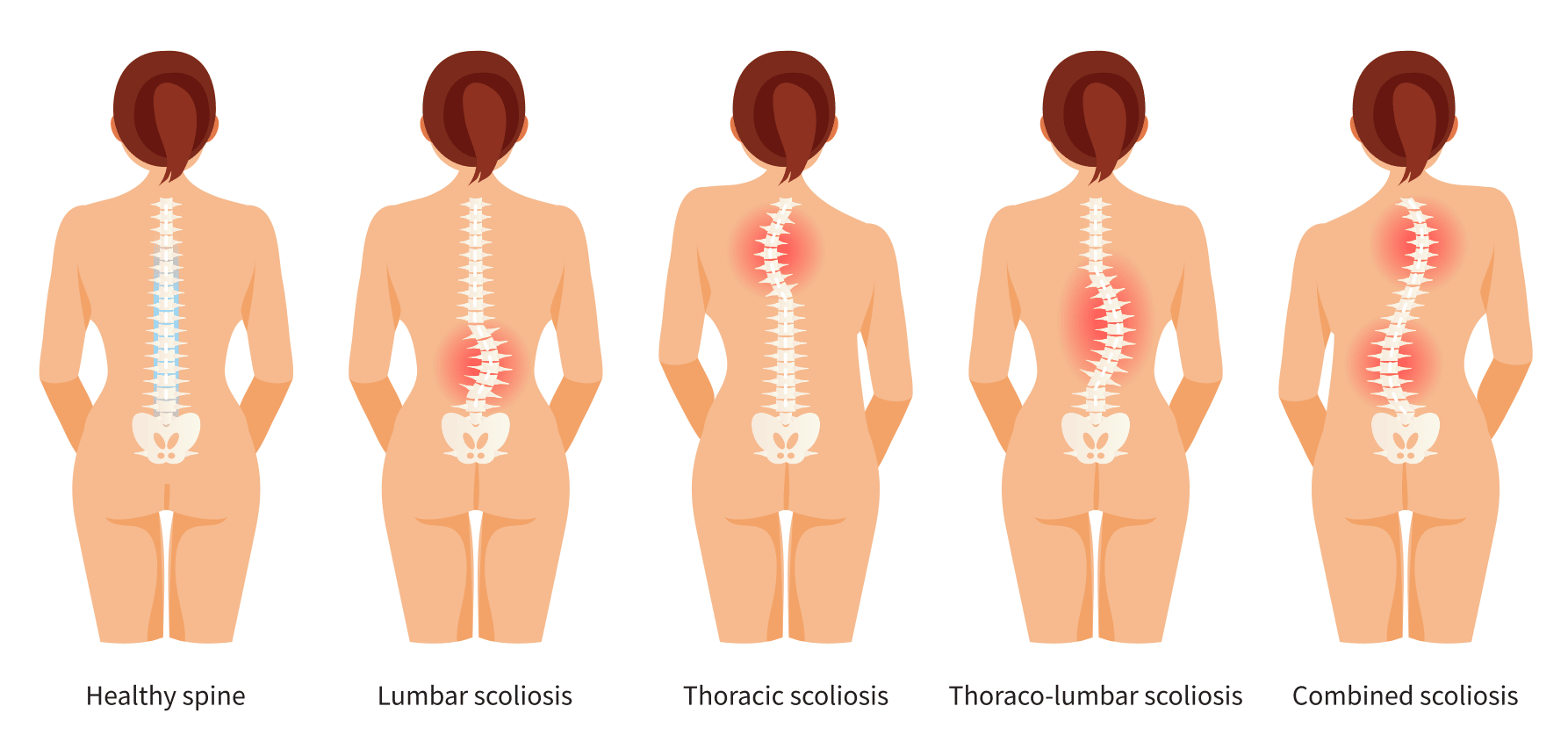 Scoliosis