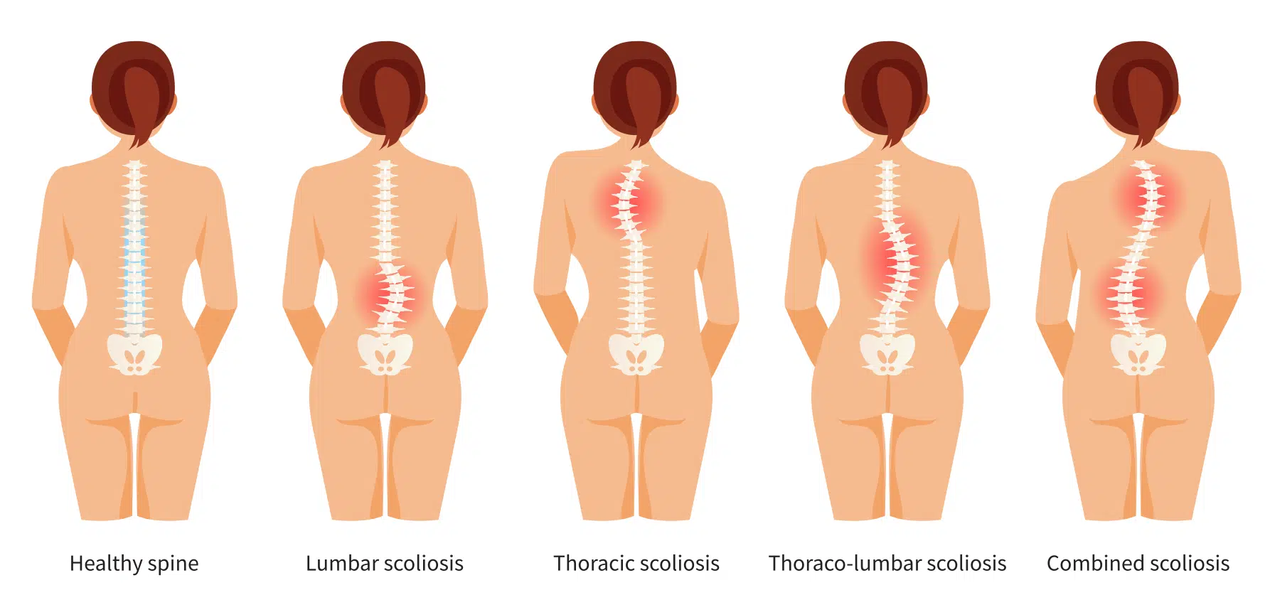 Scoliosis