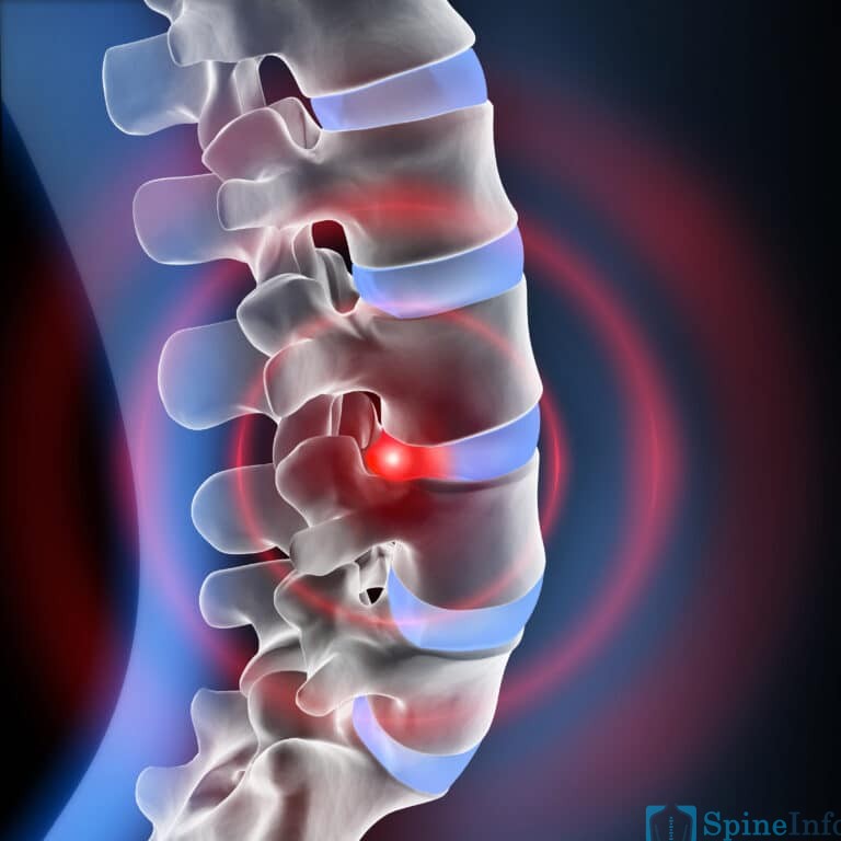 Degenerative Disc Disease: Definition, Causes, Symptoms, Diagnosis, and ...