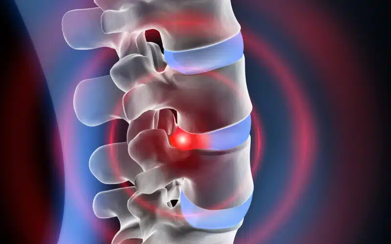 Disc Degeneration in Spine