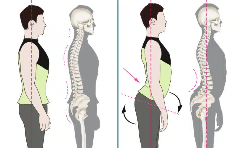 Lordosis