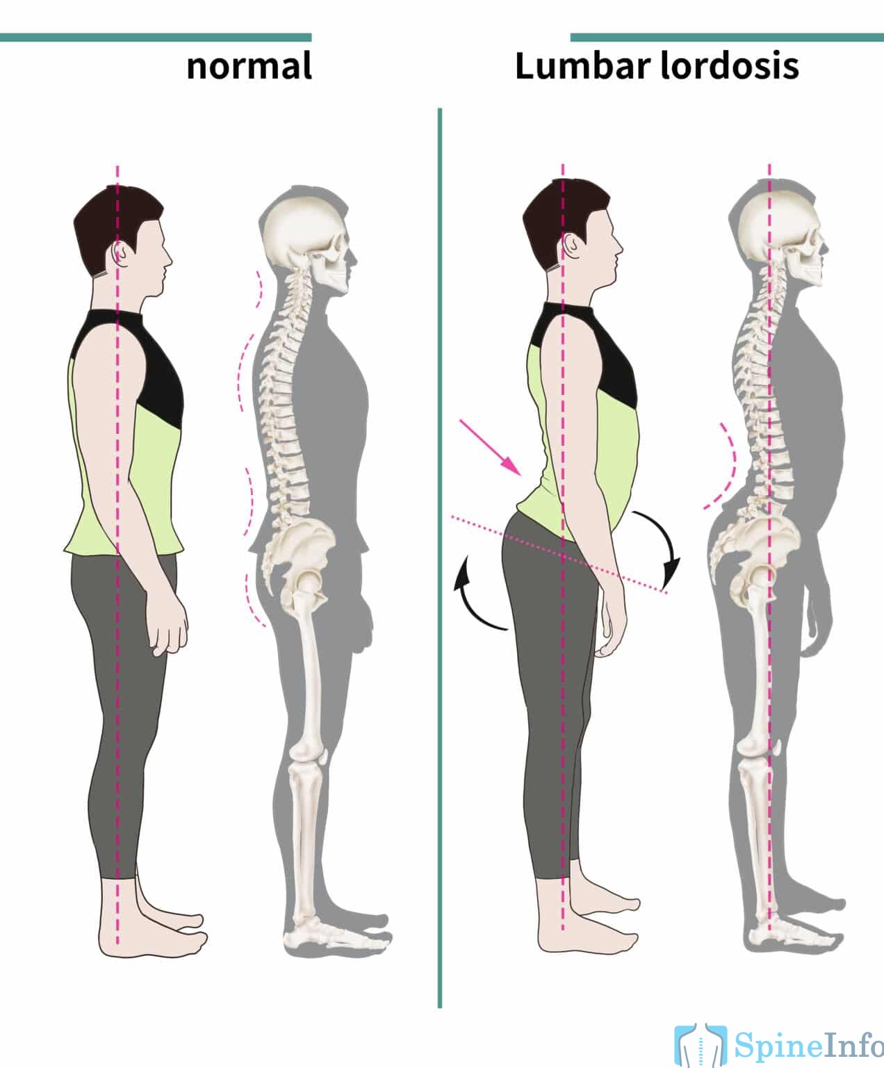 Exercises for Lordosis Strengthening and Stretching Techniques Spine