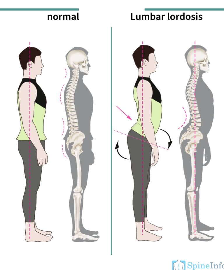 Lumbar Lordosis Definition, Causes, Symptoms, Diagnosis, and Treatment