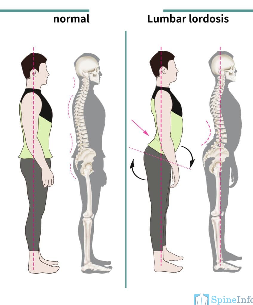 Lordosis