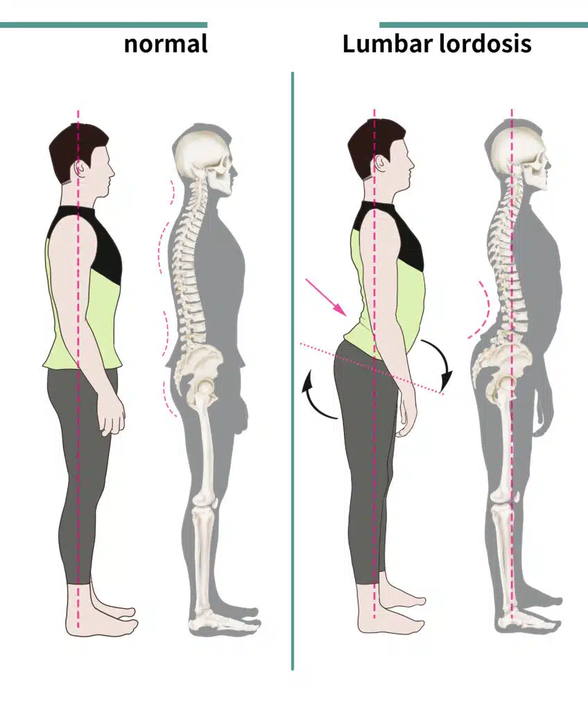 Lordosis