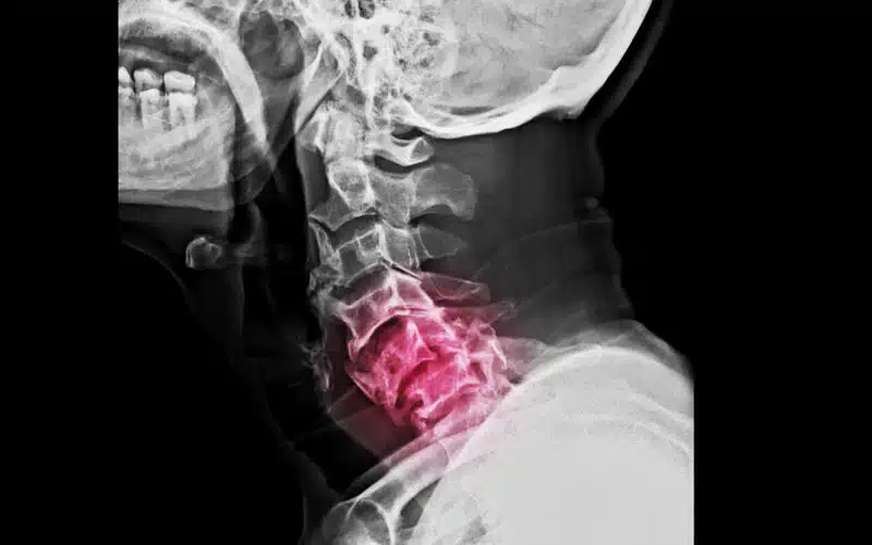 Lateral Projection of Cervical Spine X-Ray and Bilateral Facet Joint