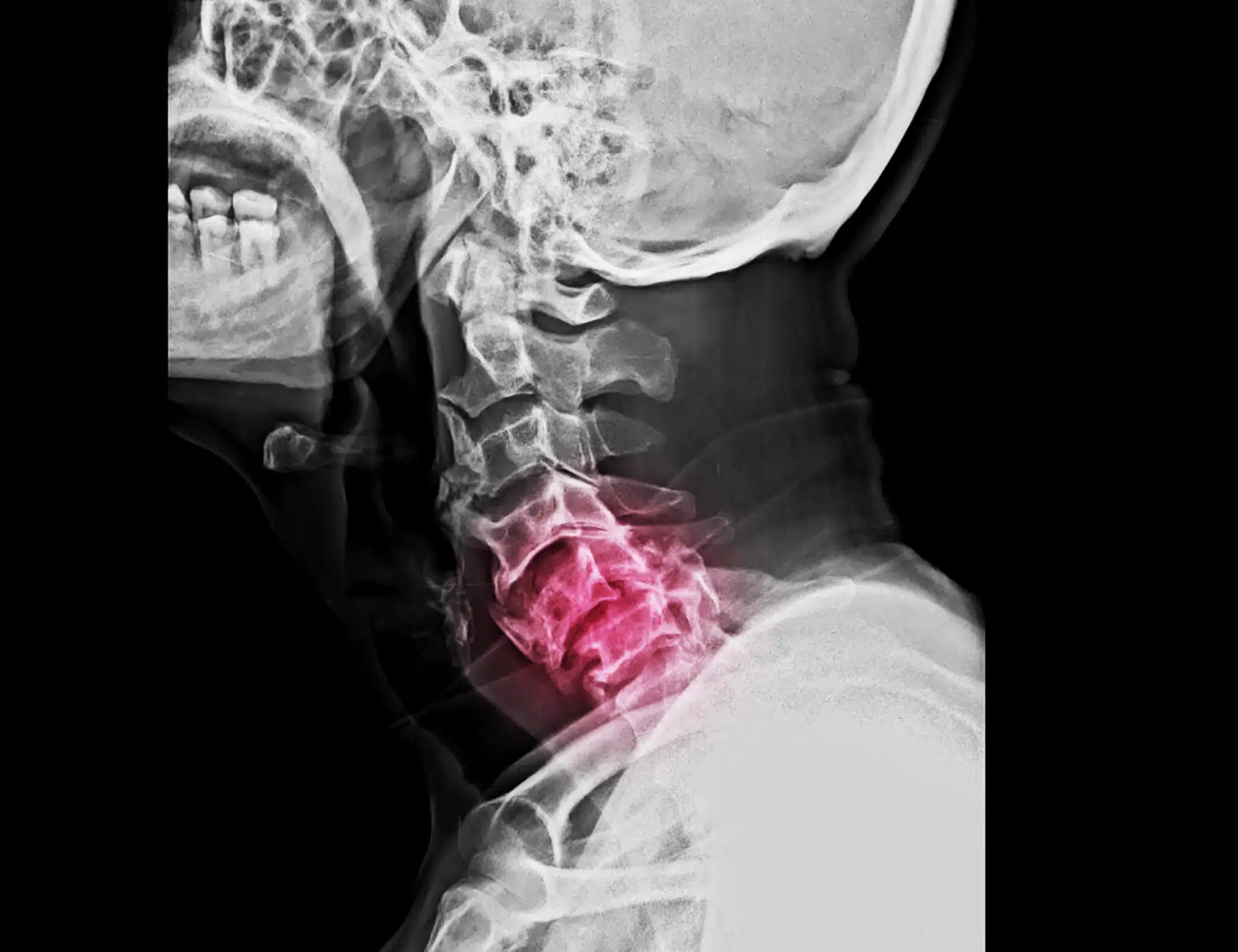 Lateral Projection of Cervical Spine X-Ray and Bilateral Facet Joint