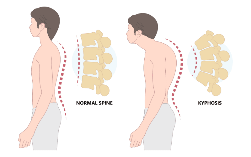 Normal Spine vs Kyphosis