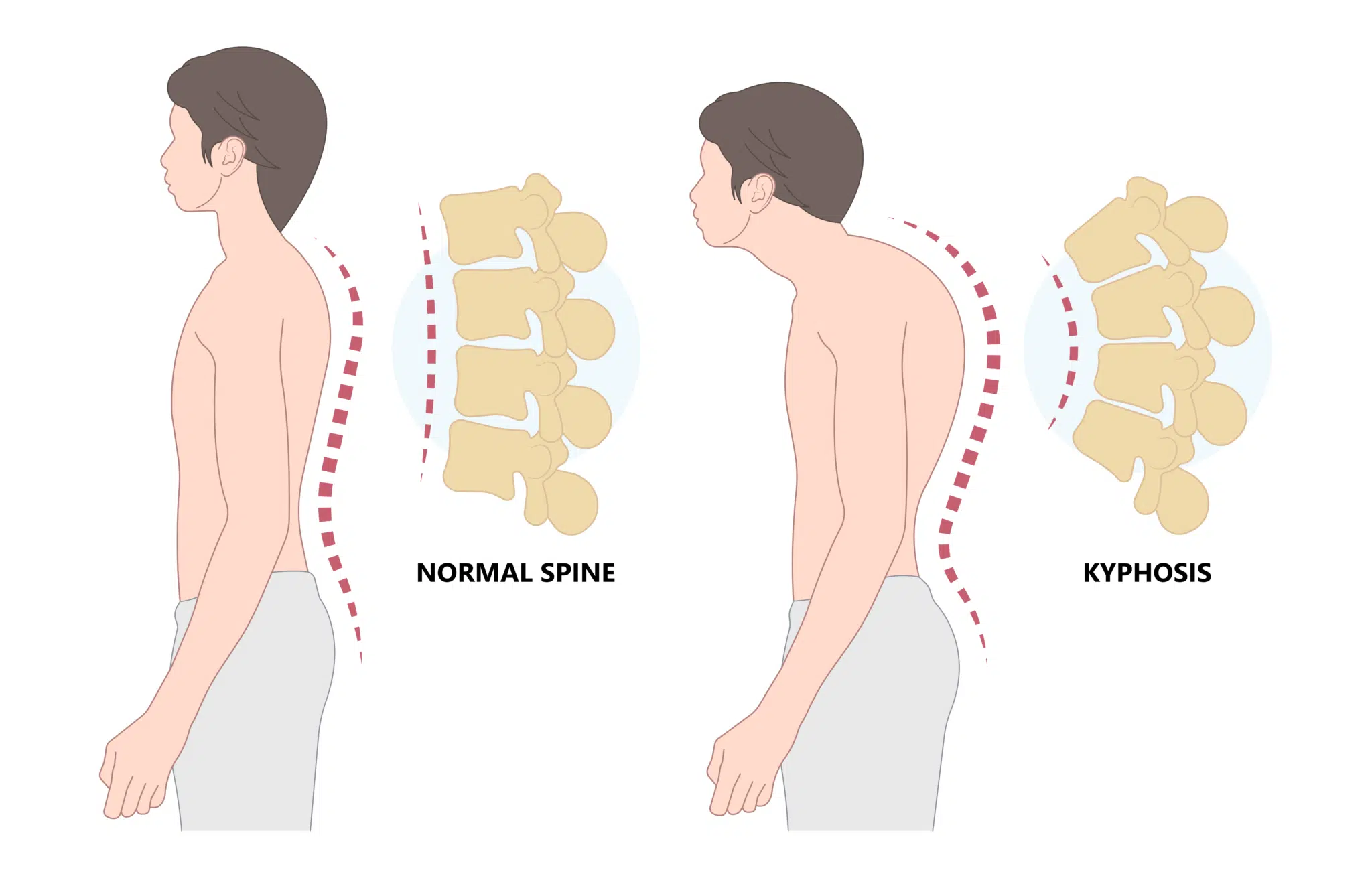 Normal Spine vs Kyphosis