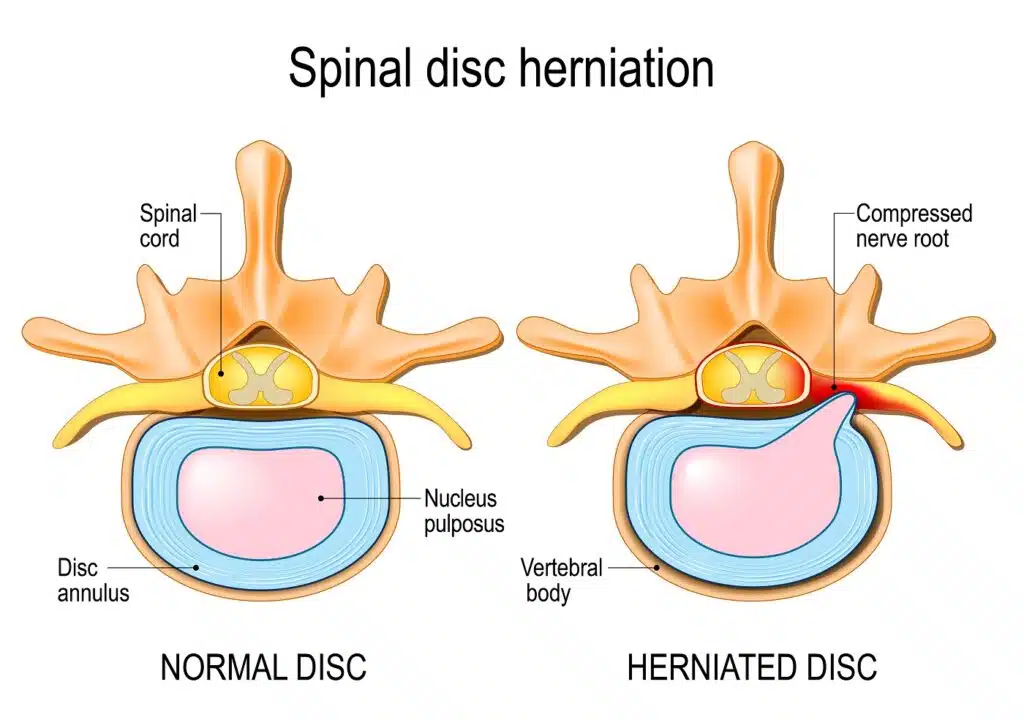 Normal Disc Compared to Herniated Disc