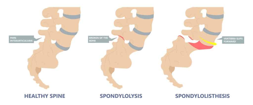 paralysis symptoms spondylolisthesis