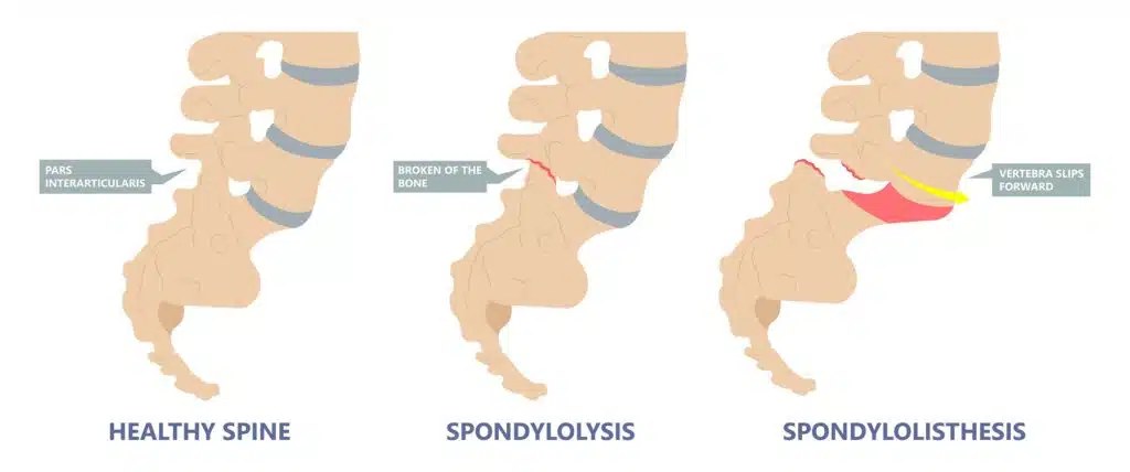traumatic spondylolisthesis symptoms
