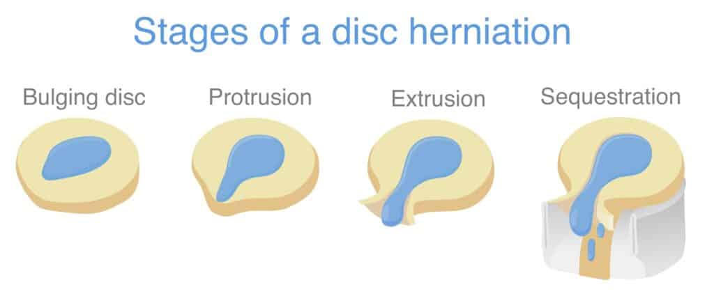 Stages of Disc Herniation