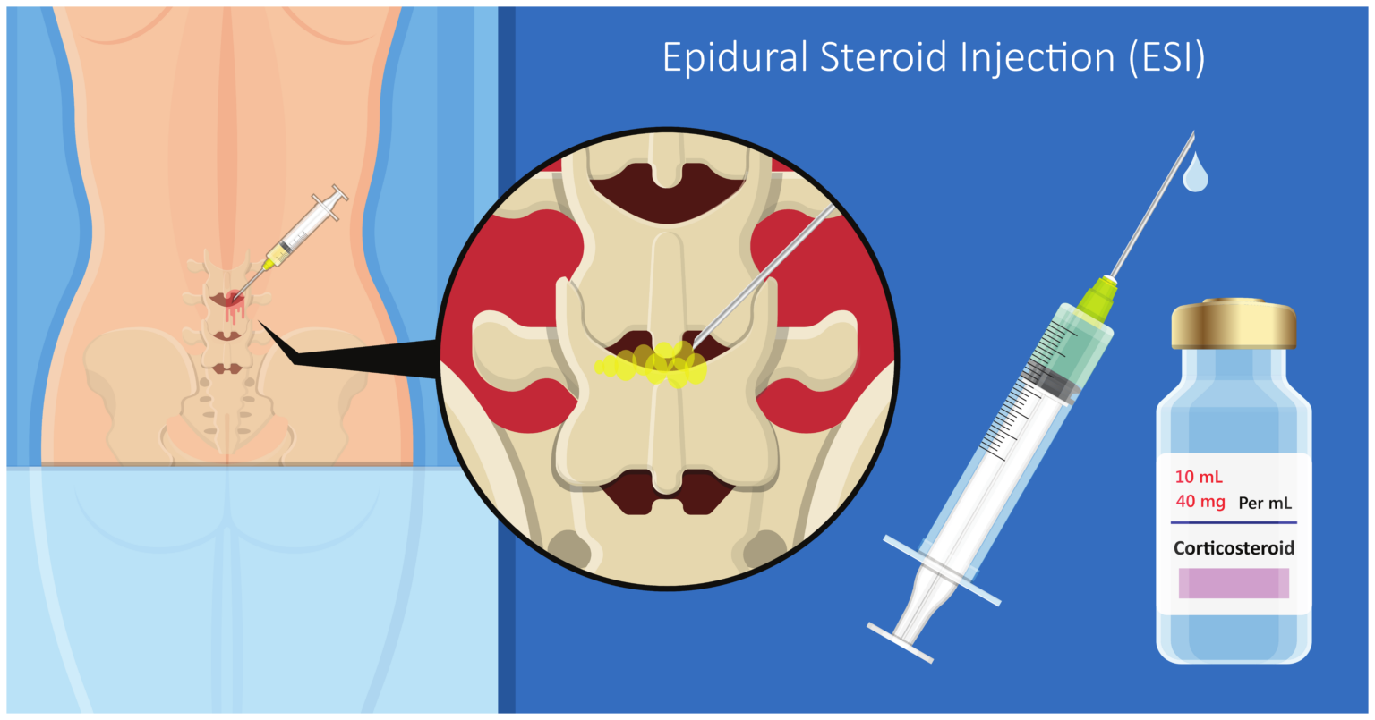 How Long Do Epidural Spinal Injections Last at Virginia Rozier blog